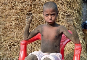 Բանգլադեշցի փոքրիկ տղան աստիճանաբար վերածվում է քարի (լուսանկարներ)