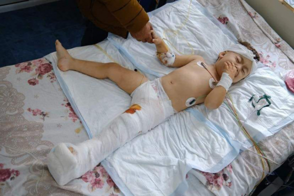 Մարտունիում ծանր ռմբակոծությունից հետո վիրավորված 2-ամյա Արծվիկը վիրահատվել է․ ռմբակոծության հետևանքով փոքրիկի 9-ամյա քույրը մահացել է