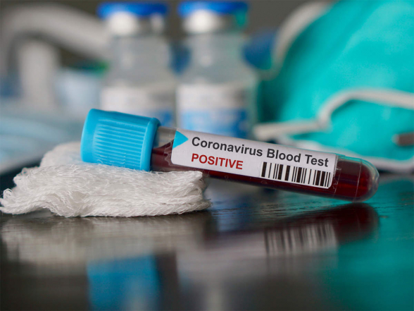 За сутки в Армении выявлено 494 новых случая коронавируса, скончались еще 19 человек